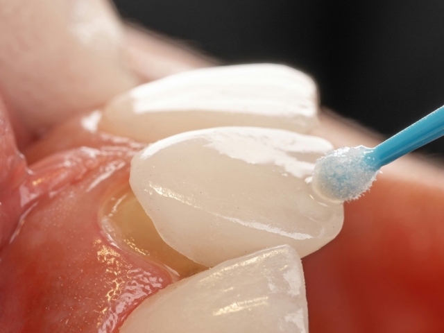  Zubne ljuskice (Veneers) 